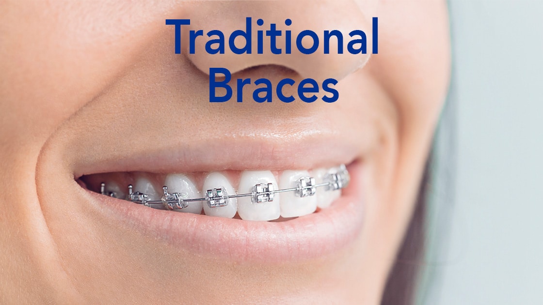 Traditional braces image