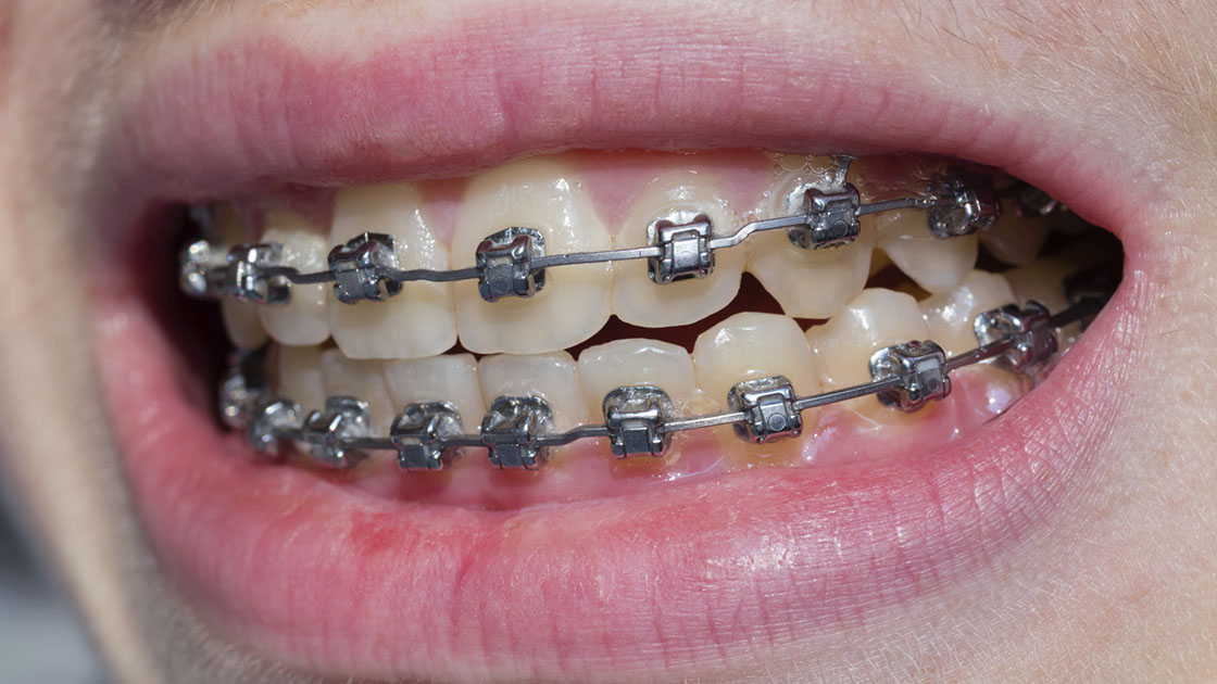 Braces to correct crossbite