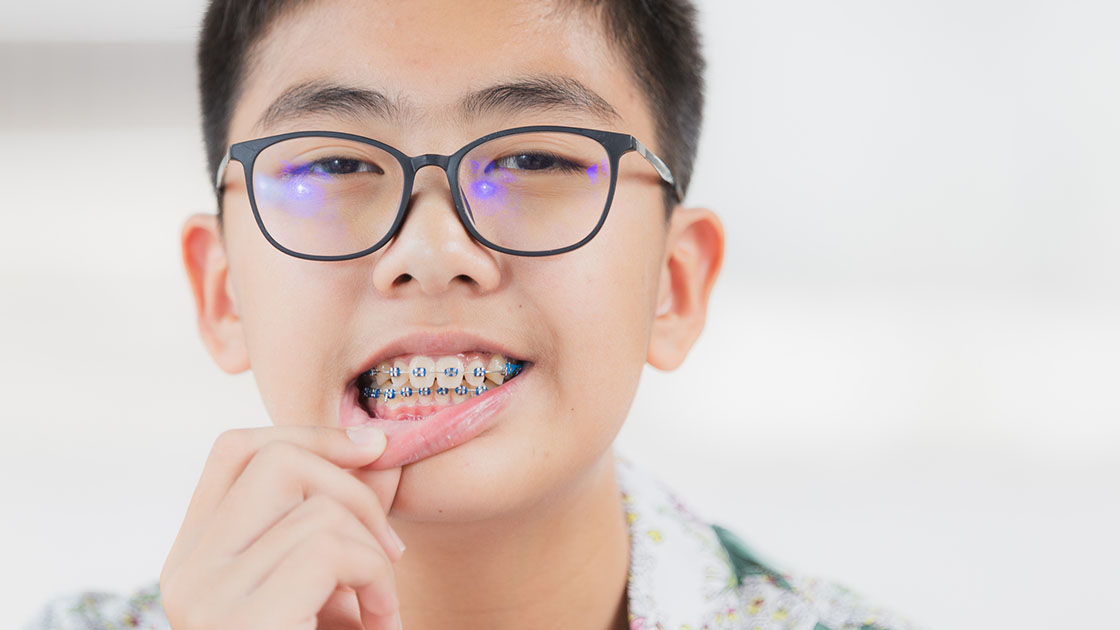 Patient Holding Lip Down Showing Braces