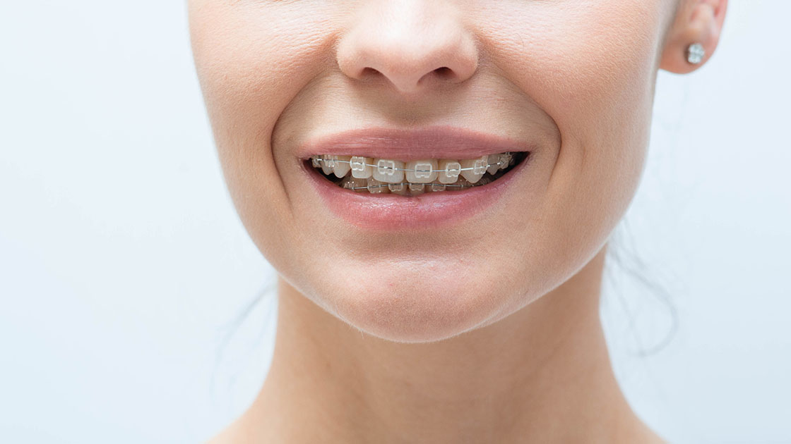 Braces to correct overbite